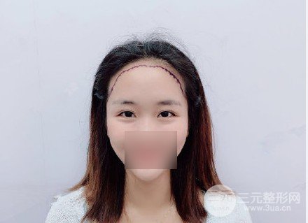 武汉市一医院植发科是外包吗