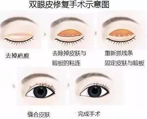 北京双眼皮修复比较好的医生有哪些