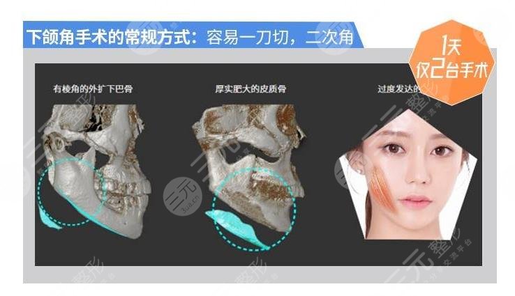 北京下颌角磨骨医生排名2022