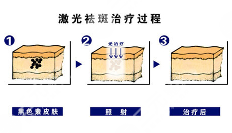 第九人民整形醫(yī)院激光祛斑怎么樣