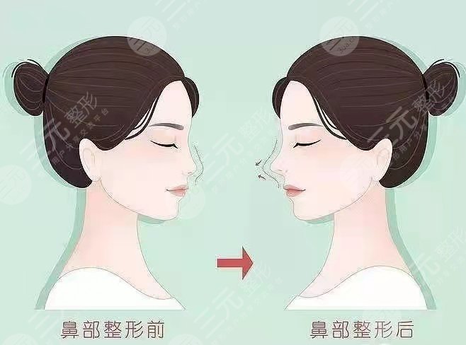 上海隆鼻专家排名
