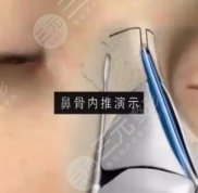 合肥葉凡修復(fù)鼻子技術(shù)怎么樣