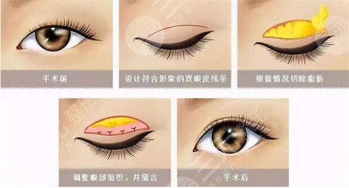 北京双眼皮修复专家名单排名