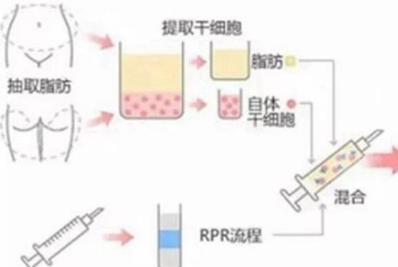 广州脂肪填充医生排名榜前三揭秘