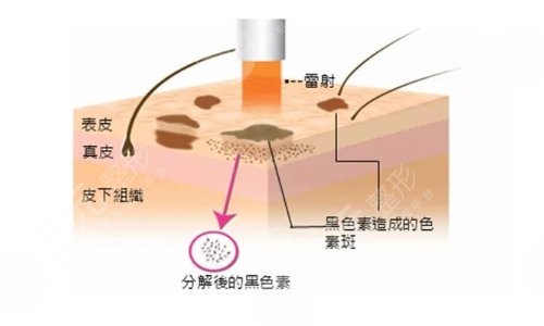 激光祛斑會反彈嗎