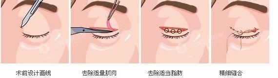 深圳富華美容醫(yī)院雙眼皮怎么樣價(jià)格表