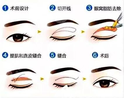 上海10大双眼皮医生