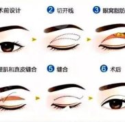 天津第一中心醫(yī)院割雙眼皮怎么樣 看完案例就知道·