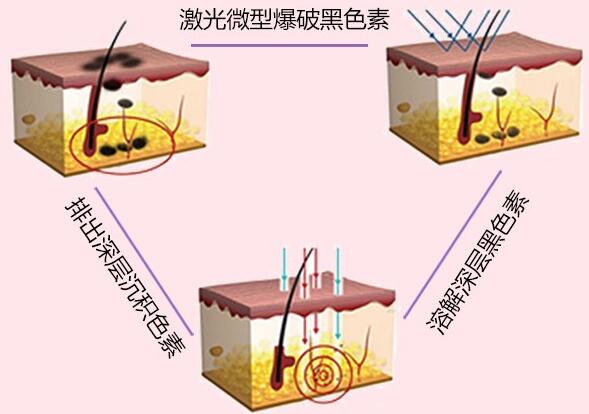 中国医学科学院皮肤病医院可以祛斑吗