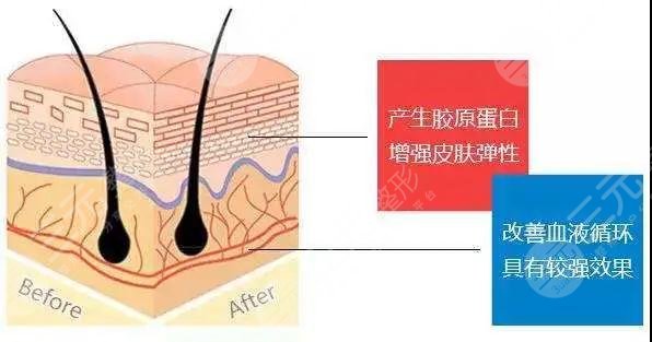 v美骨雕和熱瑪吉的區(qū)別講解