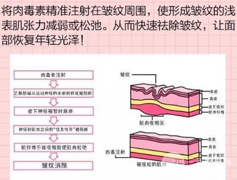 rd素除皺