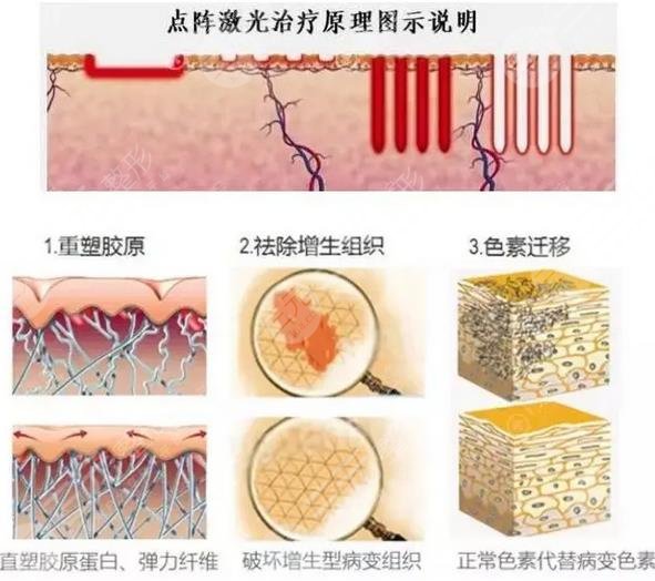 山大一院點陣激光價格多少