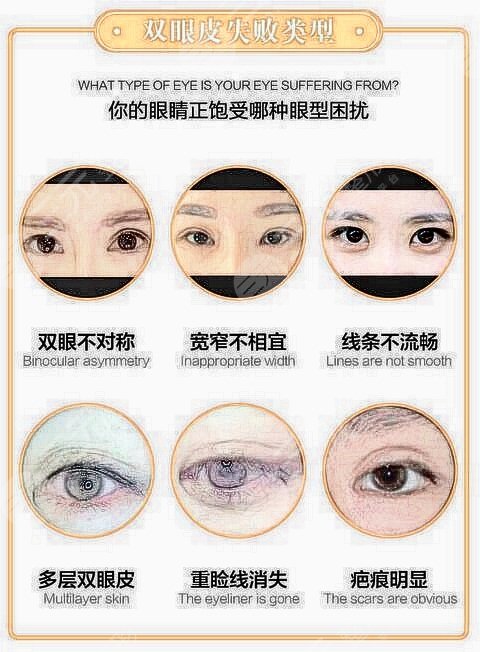 上海做双眼皮修复好的医生是哪位