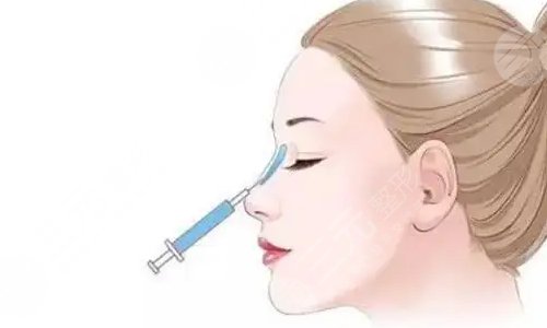 玻尿酸隆鼻可以维持多久