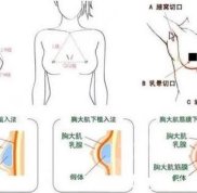 南京乳房整形好的醫(yī)生大比拼