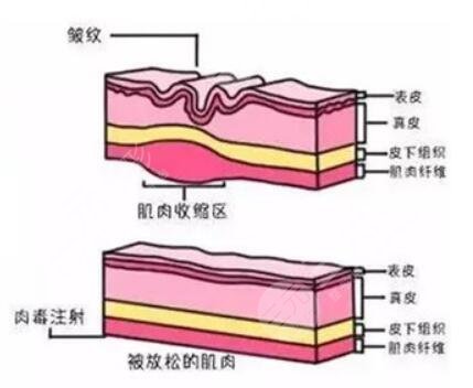 內(nèi)窺鏡面部提升手術(shù)果怎么樣