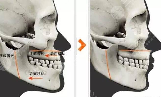 女性男性過大下頜角整形和手術(shù)對(duì)比照片 磨骨多少錢