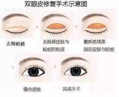广州双眼皮修复专家
