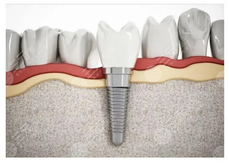 正规医院种植牙多少钱一颗