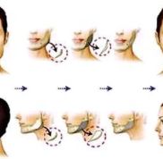 長沙愛思特醫(yī)療美容醫(yī)院磨骨怎么樣多少錢