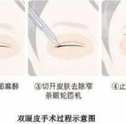 鄭州做雙眼皮哪家醫(yī)院專業(yè)又好