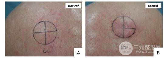 A型注射瘦脸的应用