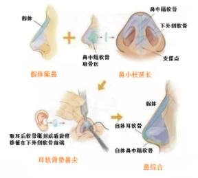 趙絳波做鼻子怎么樣