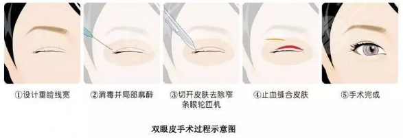 广州南方医院双眼皮手术哪个医生好