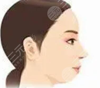 北京叶美人面部吸脂面部轮廓塑形