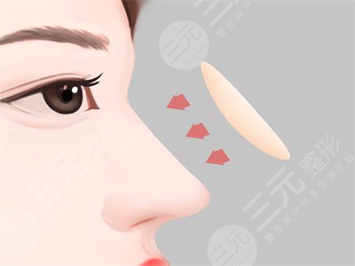 杭州时光隆鼻割双眼皮整形价格表和医院介绍