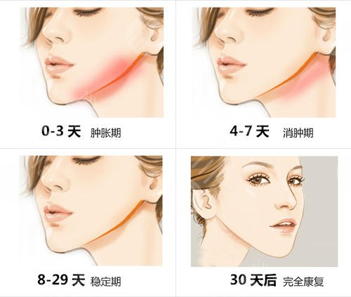 北京罗金超下颌角做过多少例