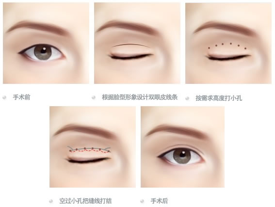 北京丽都医疗美容医院双眼皮价格是多少