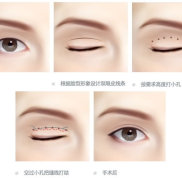 北京麗都醫(yī)療美容醫(yī)院雙眼皮價格是多少