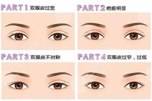 上海双眼皮修复专家排名