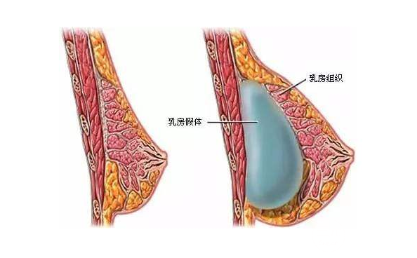 豐胸后遺癥科普