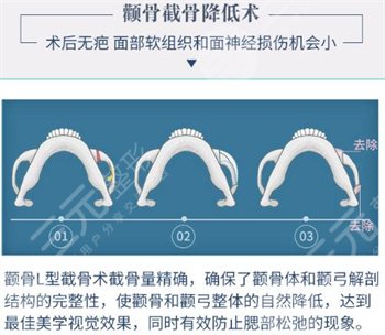 2022中国磨骨医生排行榜重磅发布