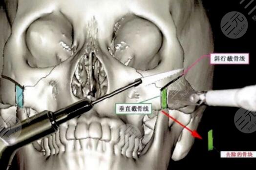 廣州美恩徐威強(qiáng)改臉型怎么樣