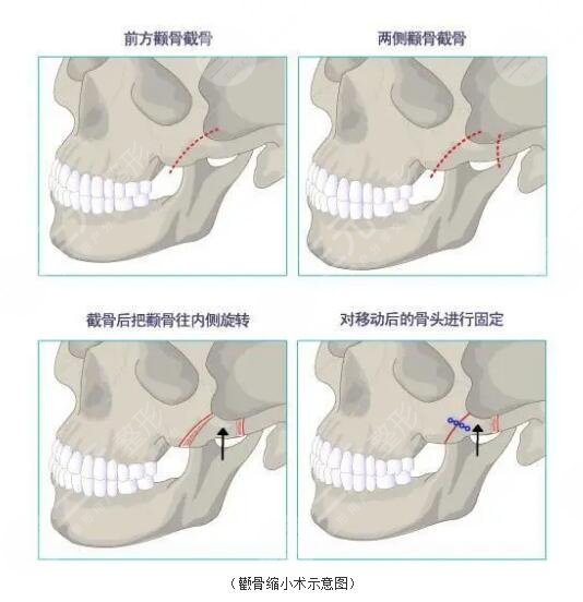 八大处刘剑锋下巴截短技术怎么样