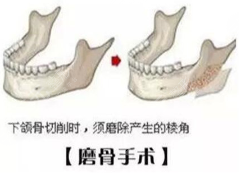 八大处尹琳磨骨怎么样