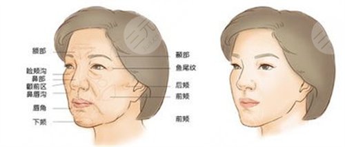 武漢三院整形科任軍案例