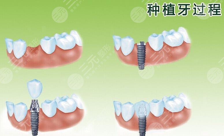 2022青島牙齒種植哪里比較好