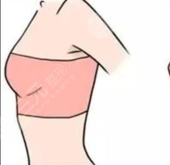 西宁韩美医学美容医院自体脂肪隆胸案例及整形项目价格