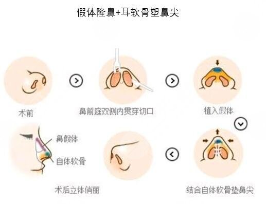 南京隆鼻医生排名榜