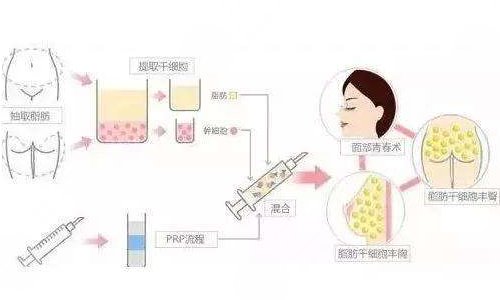 自體脂肪填充太陽凹陷能維持多久