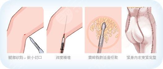 萊蕪背部吸脂醫(yī)院排名名單來襲