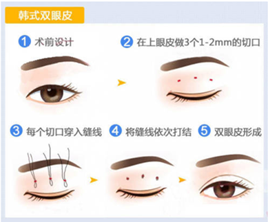 上海比利华医院割双眼皮价格是多少