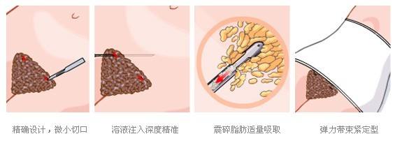 任學(xué)會吸脂怎么樣