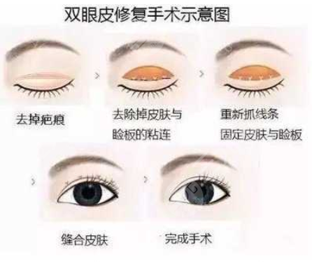 上海双眼皮修复厉害医生名单