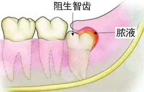 拔智齒多少錢一顆