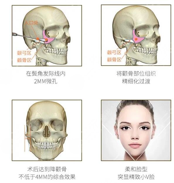 颧骨磨骨能磨几毫米